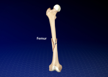 Disarticulation of the Femur: A Comprehensive Exploration