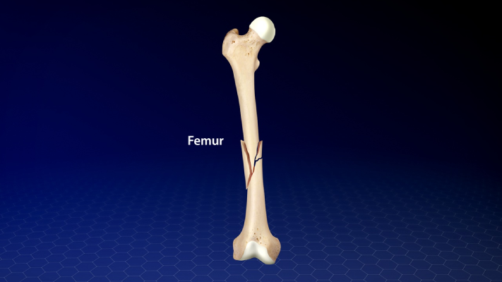 Disarticulation of the Femur(Bossier Othopedics)